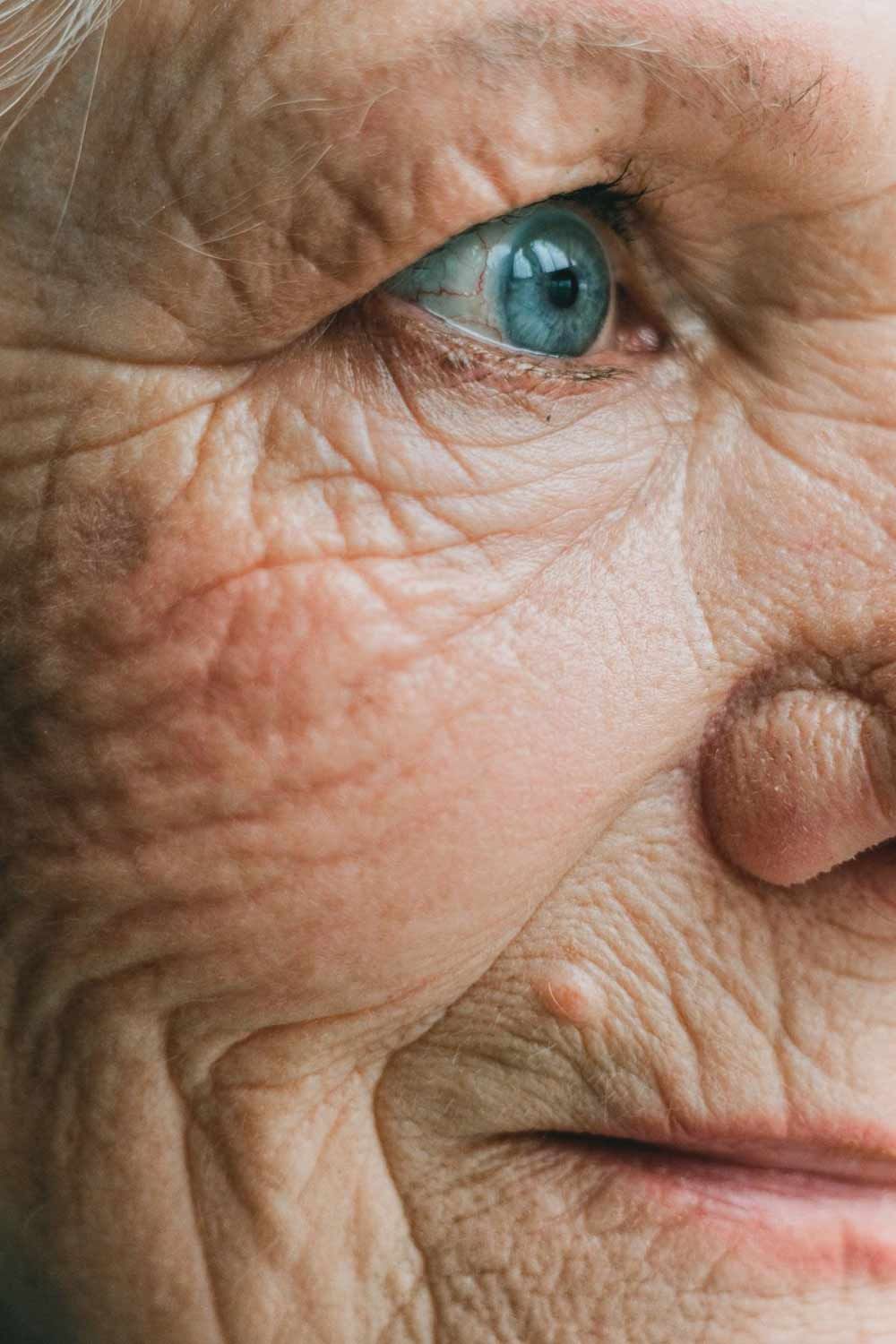 Elderly Woman Before Skin Resurfacing in Cincinnati