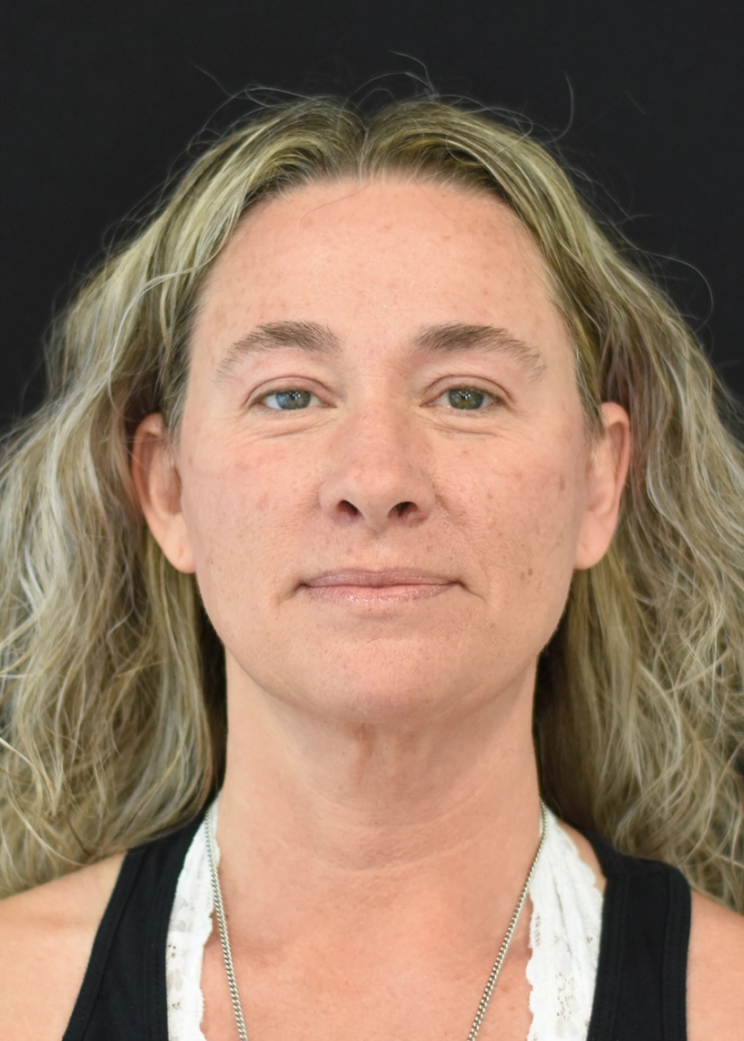 Extended Deep Plane Facelift Patient 3 Set 1 After