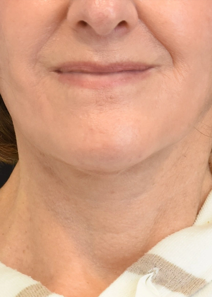 Deep Plane Facelift Patient 33 Set 1 After
