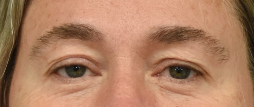 Eyelid Surgery Patient 7 Set 1 Before