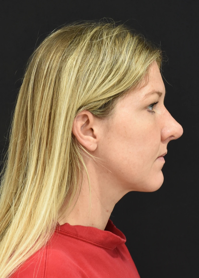 Rhinoplasty Patient 3 Set 2 After