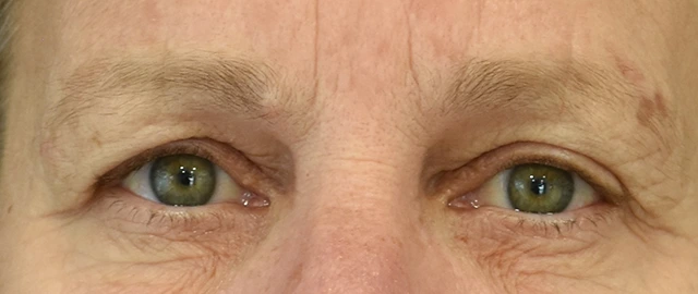 Brow Lift Patient 14 Set 1 Before