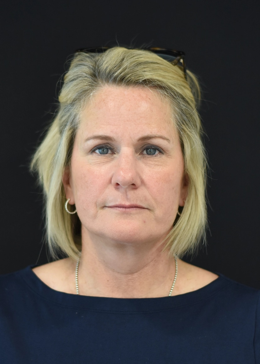 Extended Deep Plane Facelift Patient 11 Set 1 After